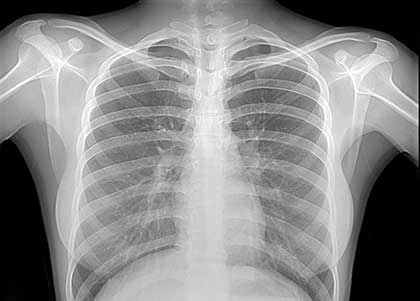 Картинки по запросу Рентген грудной клетки