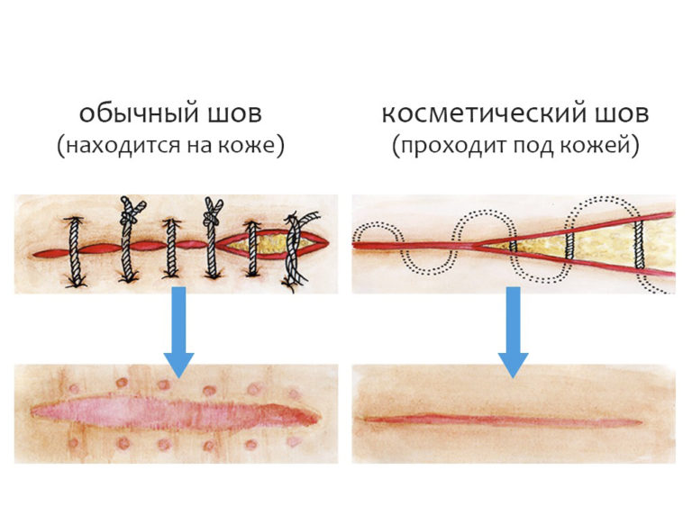 Как снять косметический шов самостоятельно Как снять косметический шов самостоятельно