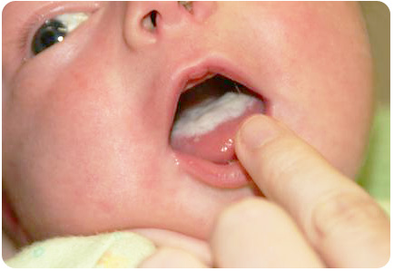 Детская молочница во рту у малыша