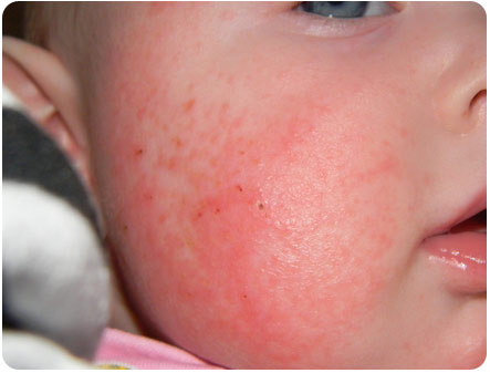 Красная аллергическая сыпь на щеках у малыша