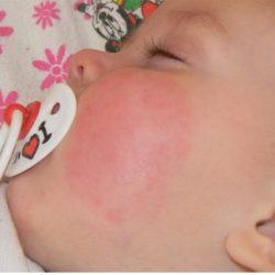 Красные щеки у грудничка – задача любой мамы найти корень проблемы! Красные щеки у грудничка – задача любой мамы найти корень проблемы!