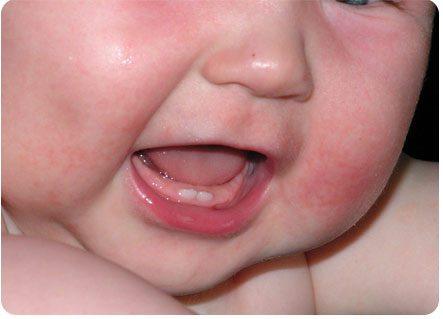 Проявления диатеза на щеках у ребенка