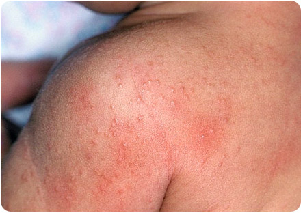 Аллергия на теле у ребенка