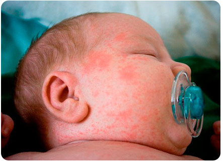 Токсическая эритема на лице у новорожденного ребенка
