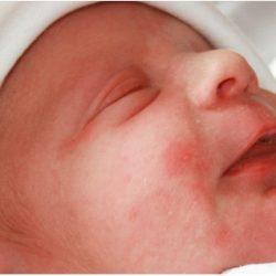 Что такое эритема новорожденных. Разновидности эритемы Что такое эритема новорожденных. Разновидности эритемы