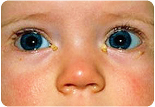 У новорожденного ребенка гноятся глаза от дакриоцистита