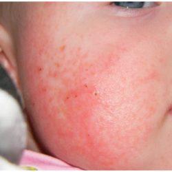 Аллергия на сладкое у малышей