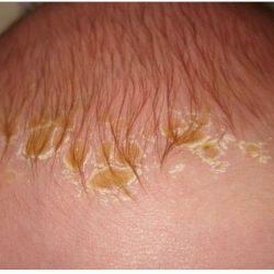 Почему появляются корочки на голове у грудничка? Почему появляются корочки на голове у грудничка?