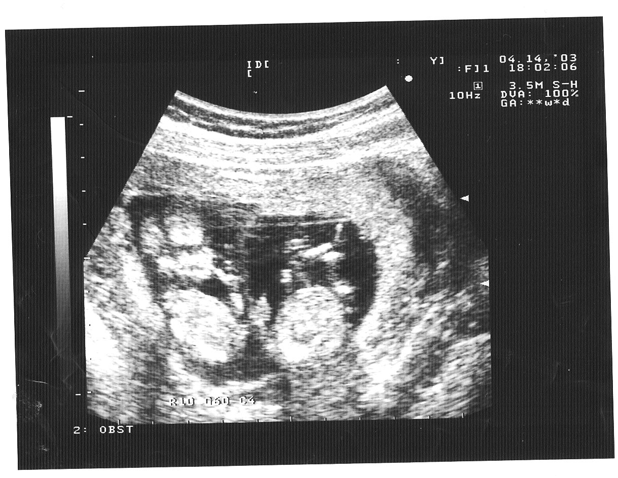 УЗИ 11 недель беременности двойня