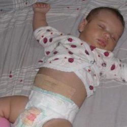 Пластырь для пупочной грыжи для новорожденных Пластырь для пупочной грыжи для новорожденных