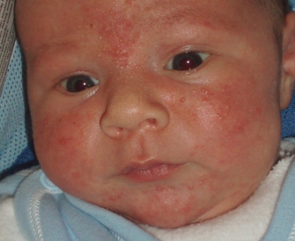 Аллергия у ребенка на персики