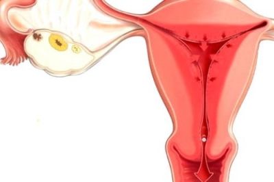 Беременность после лечения хронического эндометрита