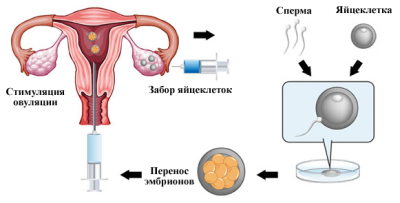 Этапы переноса эмбриона