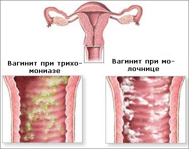 Молочница у женщин