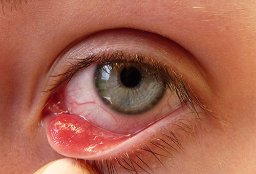 Появления ячменя с внутренней части глаза
