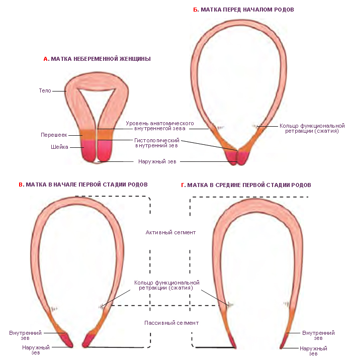 Сегментирование матки кольцом функциональной ретракции в процессе родов