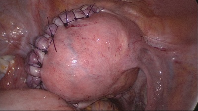 Так выглядит матка после удаления большого миоматозного узла (диаметр 12-14см) на фоне временного клипирования маточных артерий