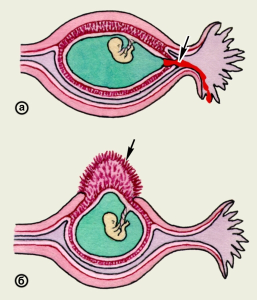 Схематическое изображение внутреннего (а) и наружного (б) разрыва плодовместилища при ампулярной трубной беременности (участки разрывов указаны стрелками)
