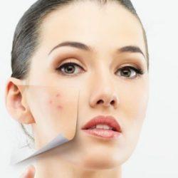 Прыщи при беременности на ранних сроках Прыщи при беременности на ранних сроках