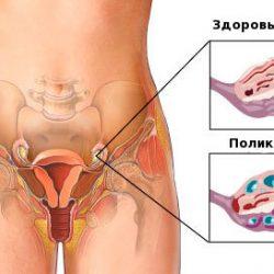 Как забеременеть при поликистозе яичников Как забеременеть при поликистозе яичников