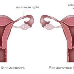 На каком сроке внематочной беременности лопается труба