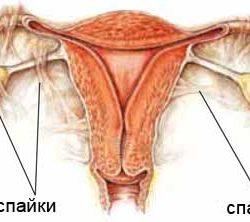 Спайки в маточных трубах: причины образования, методы лечения Спайки в маточных трубах: причины образования, методы лечения
