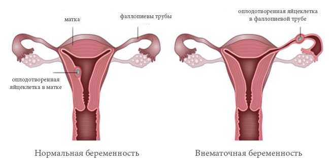 Расположение эмбриона при внематочной беременности