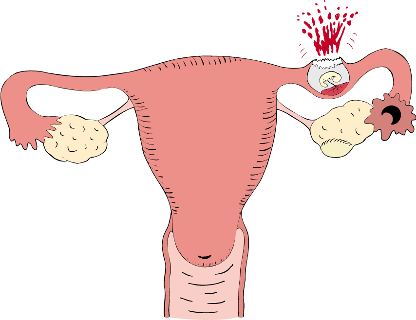 Разрыв трубы при внематочной беременности