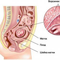 Отслойка хориона на ранних сроках беременности