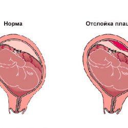 Отслойка плодного яйца на ранних сроках беременности Отслойка плодного яйца на ранних сроках беременности