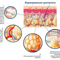Причины возникновения целлюлита после родов и методы избавления от него