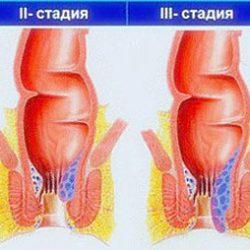Применение препарата Релиф во время беременности Применение препарата Релиф во время беременности