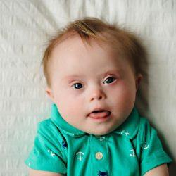 Синдром Дауна: признаки и симптомы, лечение Синдром Дауна: признаки и симптомы, лечение