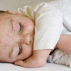 Высыпания у новорожденных. Причины и виды сыпи. Уход и питание новорожденного Высыпания у новорожденных. Причины и виды сыпи. Уход и питание новорожденного