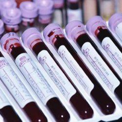 PDW в анализе крови PDW в анализе крови