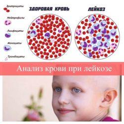 Анализ крови при лейкозе Анализ крови при лейкозе