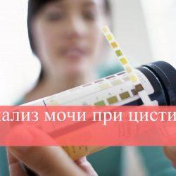 Анализ мочи при цистите