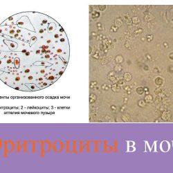 Эритроциты в моче Эритроциты в моче