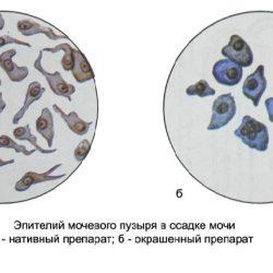 Эпителий плоский в моче