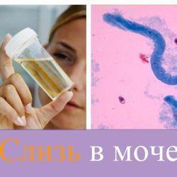 Слизь в моче Слизь в моче