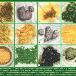 Копрограмма кала расшифровка у детей Копрограмма кала расшифровка у детей