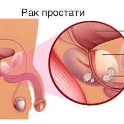 Аналіз на ПСА: як він допомагає діагностувати рак простати?