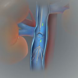 Имплантация кава-фильтра: как защитить легкие от тромба